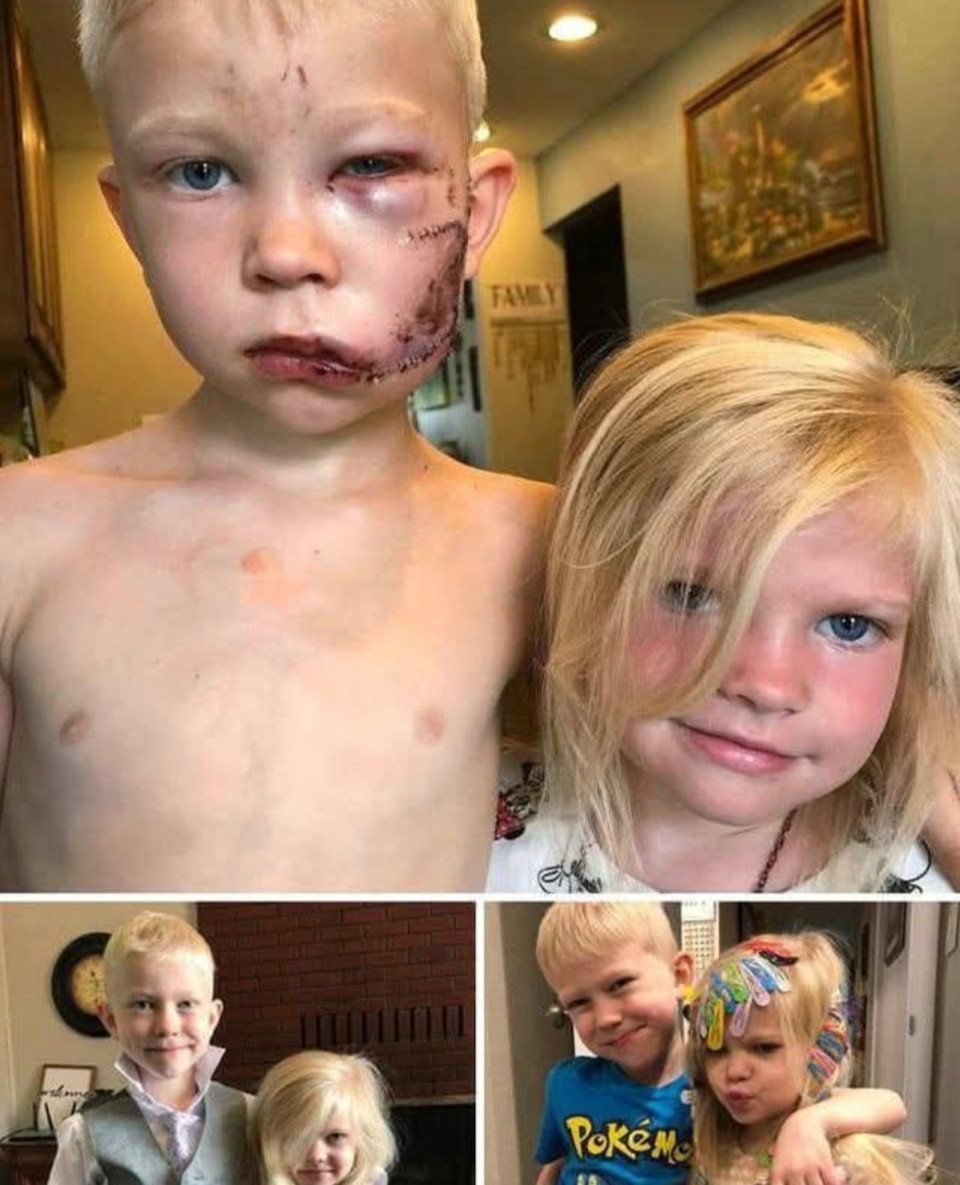 ❤️A képen látható kisfiú kapta meg a történelem legmegérdemeltebb bokszövét, mert megmentette a húgát egy nagy, veszett kutyától. 90 öltéssel varrták össze az egész testét, de megmentette hároméves húgát a biztos haláltól. Azt mondta: „Ha valaki meg fog halni, az én leszek, én vagyok a báty.” A Boksz Világtanács (WBC)  világbajnokként ismerte el a tettét és egy napig ő tartja a hivatalos WBC-rekordot a világ legjobb bokszolójaként. Hatalmas tisztelet illeti meg ezt a srácot. ❤